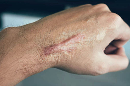 زخم، بریدگی و جای جراحی